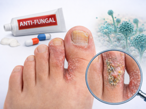 Anti Fungal